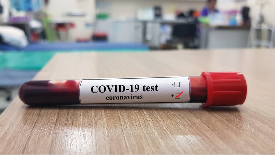 Symbolbild: Positiver COVID-19-Test und Laborprobe von Bluttests / © joel bubble ben (shutterstock)