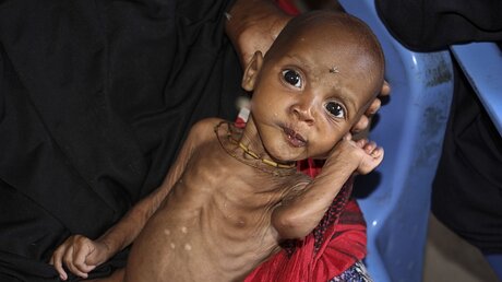 Unterernährtes Kind in Mogadischu / © Farah Abdi Warsameh (dpa)