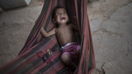 Viele Kinder in Venezuela sind unterernährt / © Rodrigo Abd (dpa)