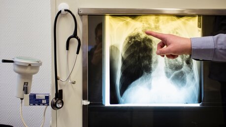 Ein Arzt zeigt einen Tuberkulose-Fall anhand eines Röntgenbildes / © Gregor Fischer (dpa)